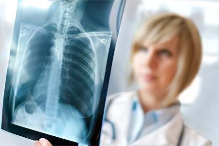 10 мифов о туберкулезе