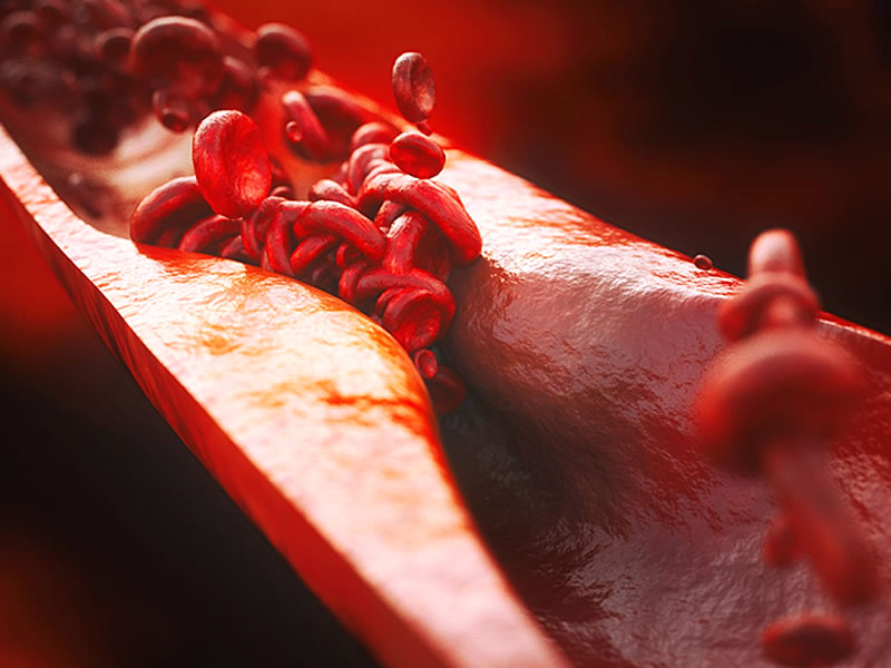 Облитерирующий атеросклероз влияние на сосуды