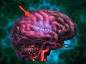 осложнения после акш