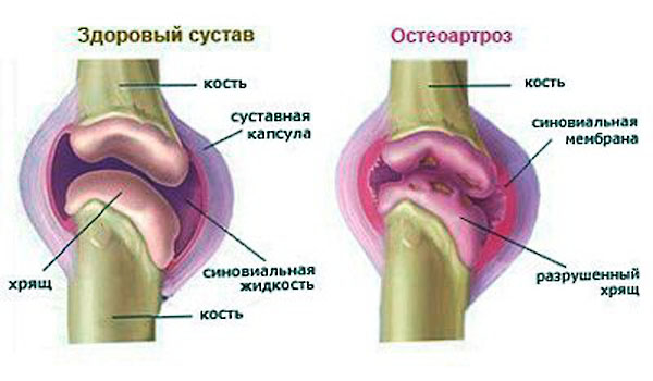 артроз сустава