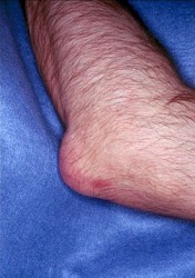 подагра поражает не только суставы ног