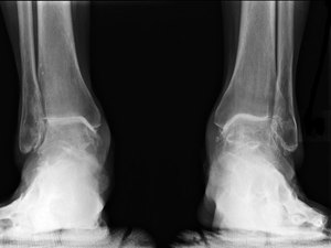 Лечение народными средствами артроза голеней