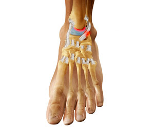 Лечим артроз голеностопного сустава