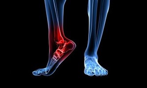 Артроз суставов