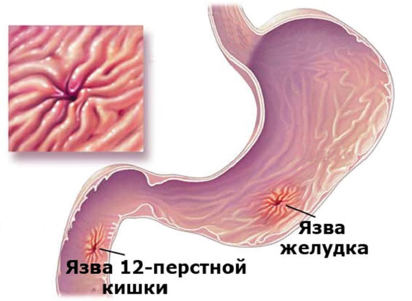 Функциональное расстройство желудка – причины и лечение
