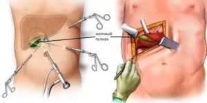 Температура после удаления желчного пузыря