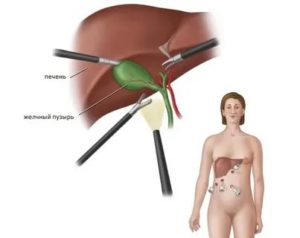 Температура после удаления желчного пузыря