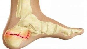 что делать если перелом реагирует на погоду