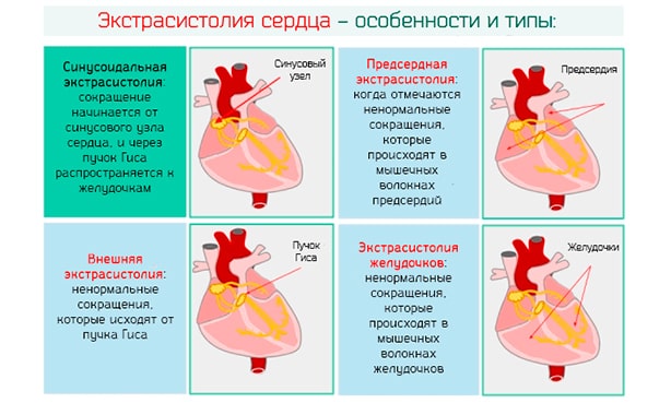 Экстрасистолия сердца