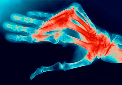 Полиартрит суставов