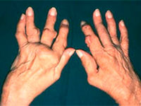 артрит пальцев рук