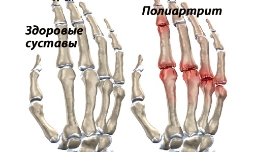 Полиартрит доброкачественный