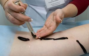 Лечение пиявками