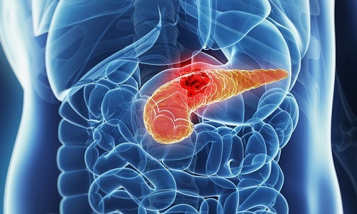 Появление субфебрильной температуры при хроническом калькулезном панкреатите должно насторожить. Ведь при этой форме заболевания часто диагностируют появление злокачественных опухолей