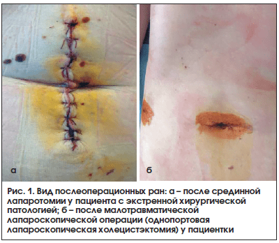 Рис. 1. Вид послеоперационных ран: а – после срединной лапаротомии у пациента с экстренной хирургической патологией; б – после малотравматической лапароскопической операции (однопортовая лапароскопическая холецистэктомия) у пациентки